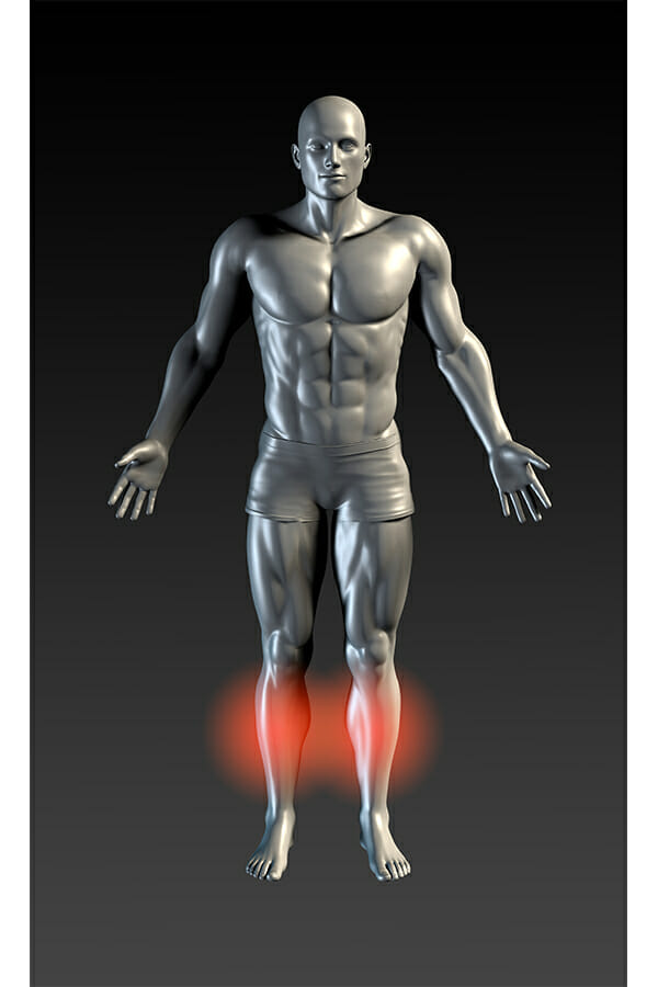 shin splints